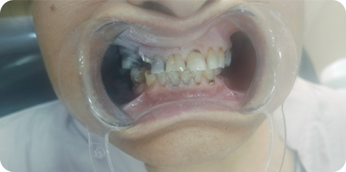 before treatment