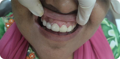after treatment