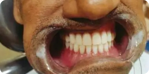 after treatment