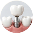 Dental Crowns and Bridges illustration