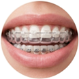 Braces and Clear Aligners illustration