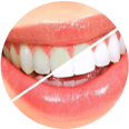 Teeth Cleaning and Polishing illustration