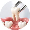 Tooth Extraction illustration